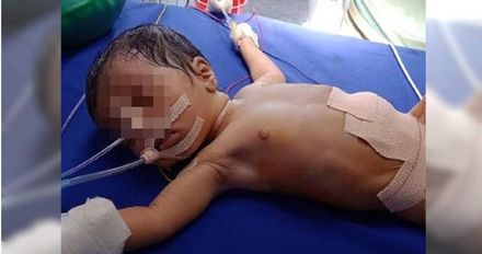 印度女嬰剛出生「肚子好大」　醫驚：體內8個寄生胎