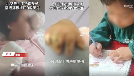 【影】心疼！女童用筷子戳插座致9根手指遭切除　病床上哭喊「不能畫畫了」