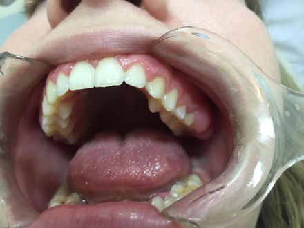 牙齒拔光也不會好！牙周病患牙拔除就好？ 醫：細菌依然存在
