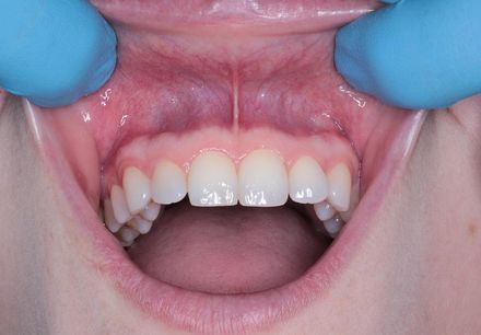 婦口腔顎骨隆突無法裝假牙　醫「手術切除成功」助重拾美味！