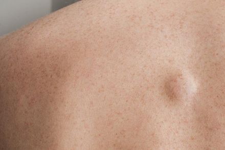 40歲男皮膚多處冒「小腫塊」！醫：基因導致多發性脂肪瘤