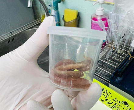 只因「愛吃生菜」！泰國孕婦頻腹痛　醫生從嘔吐物中找出2條「超長蛔蟲」