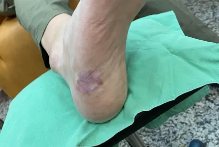 彰化警員腳底長出「大顆腫塊」　跛腳2年就醫查出病毒疣作怪