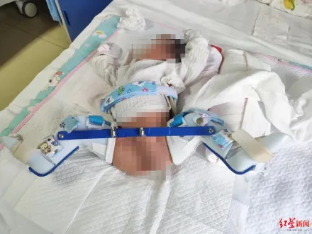 男嬰出生2天狂哭不止…送醫才知大腿骨折　家長怒控遭剖腹產醫師用力過猛掰斷