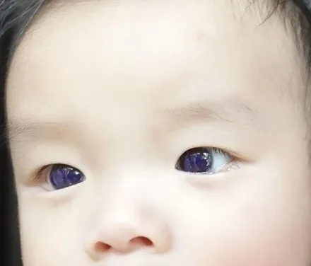 服「法匹拉韋」治新冠！一夜之間泰國男嬰變「藍眼睛」