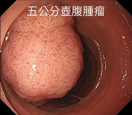 60女胃痛就醫　內視鏡檢查竟見「5公分的壺腹腫瘤」堵住十二指腸二分之一！