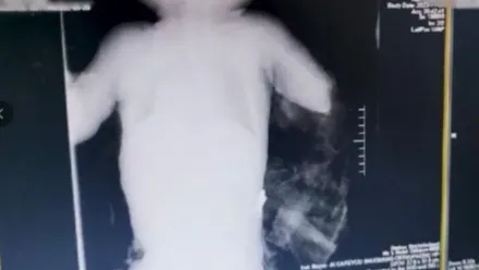 恐怖！1歲半男童慘遭藏獒「一口扯斷手臂」　醫花6小時成功接回