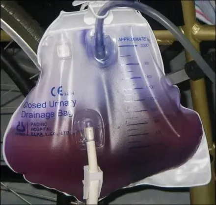 尿怎麼是紫色的？醫解釋和「泌尿道感染」相關：還可以治療
