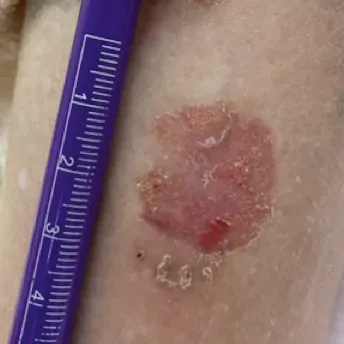 有圖慎入！脫屑紅斑「不痛不癢」竟是癌　3大常見皮膚癌曝