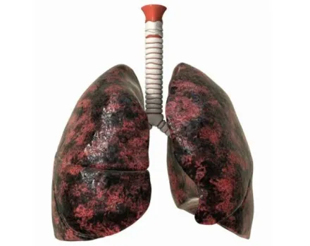 10年X光未發現！男子LDCT檢查揪出肺癌　醫師提醒：五種症狀就要當心