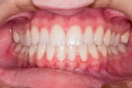 「臼齒長結節」小心牙根遭感染！醫揭「2症狀」快就醫