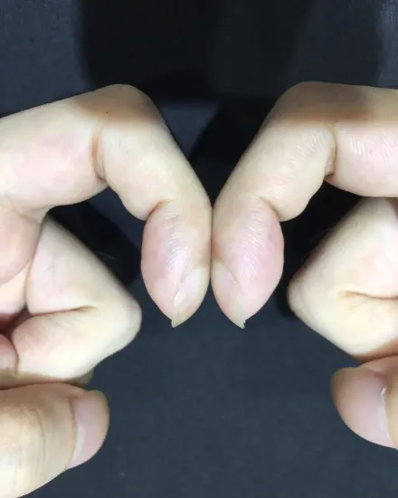 指甲變得厚又圓？「杵狀指」恐是患肺癌早期徵兆　一動作測試能救命